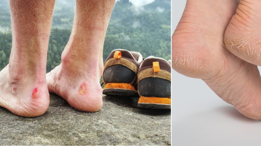 Exfoliating foot pads with tea tree oil for different foot concerns